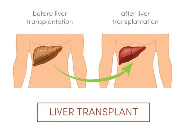Liver Replacement Surgery