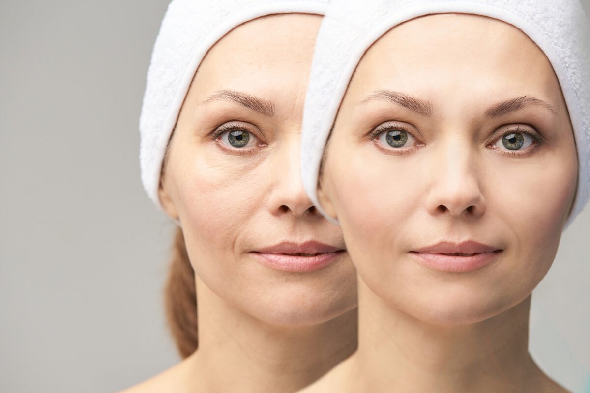 under eye bag removal surgery