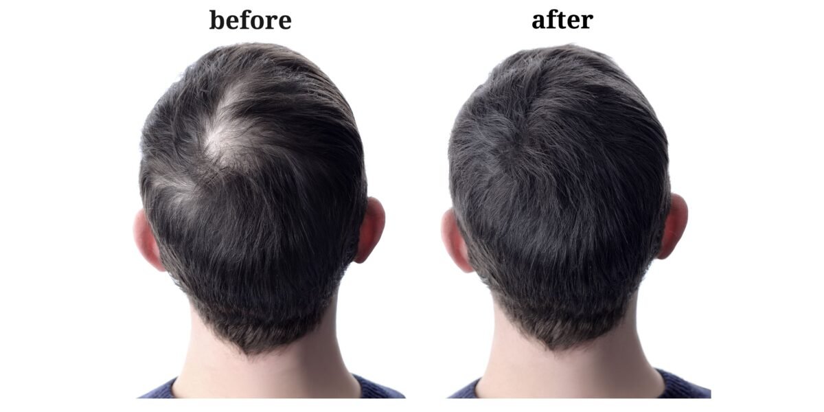 hair transplant in Chandigarh