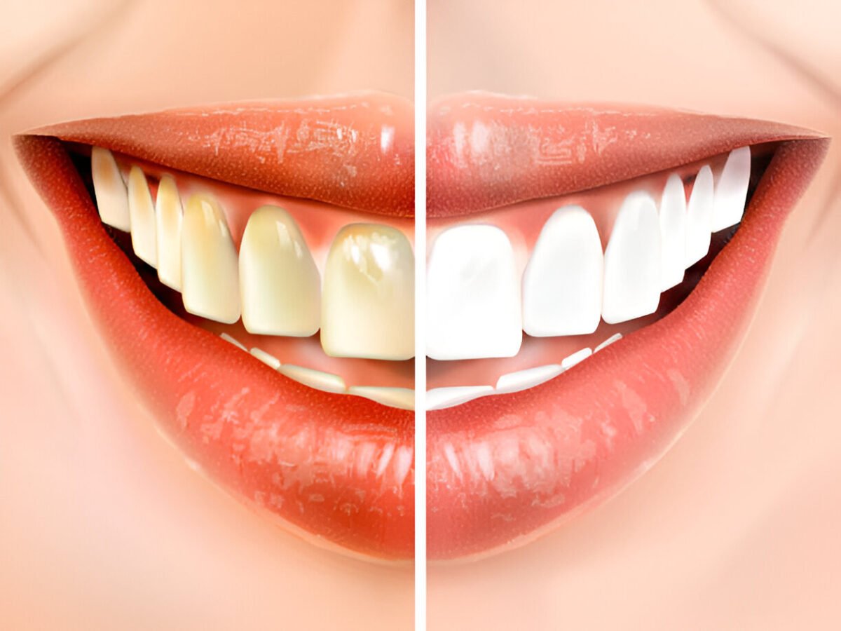 teeth whitening aberdeen