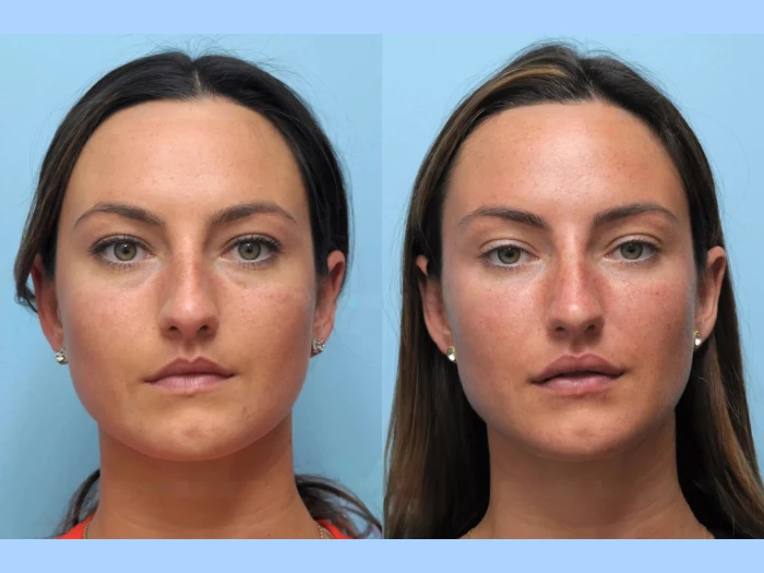 Affordable Options with the Best Doctors in Dubai for Thread Lift