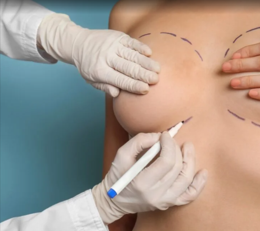 Breast Augmentation In Dubai